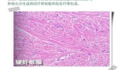 细胞基质纤维(细胞基质纤维胶原蛋白黑色素瘤)