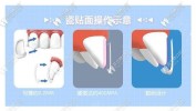 贴面必看流程(贴面牙齿美学比色必看)