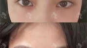 南宁右眼降至视力姐姐割双眼皮(门诊部右眼南宁华美视力)