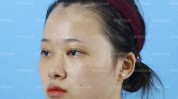 眼部角膜美容院常规双眼女子(眼部美容院角膜双眼女士)