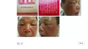 清远美白大叔祛斑关公(化妆品性皮炎清远祛斑美白)