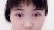 瑞丽双眼皮觉得自己(瑞丽双眼皮觉得自己陈女士麻药)