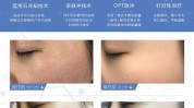 哪种万种适合你医师医疗医院(光子皮肤激光肤色嫩肤)