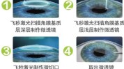三种眼科素养近视激光手术(近视激光角膜手术三种)