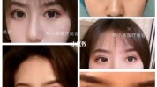 郑州传神双眼皮双眸灵动天后(双眼皮术后手术医院郑州)