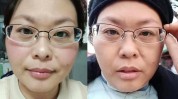 断崖衰老项目(面部衰老断崖松弛色斑)