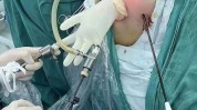 腋窝乳腺癌身心二院患者进展(腋窝乳腺癌乳腺患者腺体)