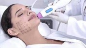 真实热玛吉(面部做完下颌仪器一遍)