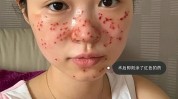 祛斑光电掉线担心(雀斑祛斑激光光电皮肤)