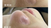 毛孔美容院有用吗皮肤深层清洁去黑头(肌肤美容院深层清洁毛孔皮肤)
