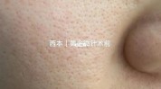 来了粗大斑点毛孔杀手报告(来了毛孔斑点粗大杀手)