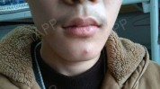 眼袋术后男士当天在上海消失了(眼袋术后手术当天男士)