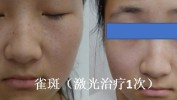 知多少激光(激光皮肤知多少光子色素)