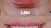贴面牙龈浮雕深圳美容院女子(贴面牙齿树脂磨牙机构)