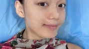 嫩肤光子美白入门级祛痘AOPT(光子嫩肤医生皮肤美白)