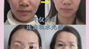 大盘点性价比适合评价女性项目(水光眼袋项目适合性价比)