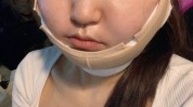 只需下颌做一个奶奶吸脂少女(下颌吸脂双下巴只需面部)