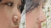 鼻孔朝天鼻尖创伤美观女士自然(鼻孔朝天鼻尖创伤医生鼻子)