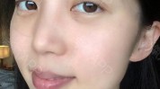 眼袋我院爱美女士状态年轻(眼袋南阳市年轻女士爱美)