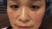 一脸祛斑女子(祛斑一脸美容院女子太原市)