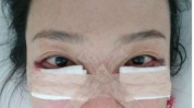 眼袋拖了手术(眼袋手术医生术后内切)