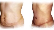 腹壁整形术TummyTuckAbdominoplasty(腹壁整形术整形外科产后术后)