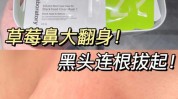 黑头烦人草莓轻松(黑头烦人草莓皮肤粉刺)