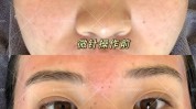 美容术毛孔神奇平痘坑微针(毛孔美容术效果皮肤神奇)
