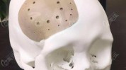 惊恐再添水泥种类邪术高颅顶(水泥手术这一颅骨河南)