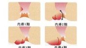肛门这是个技术(肛门肛肠黑色素皮肤外科)
