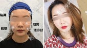 长沙术后术前求美者韩华美(长沙手术脂肪线上女士)