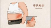 涟源疱疹省级疗法结束项目(疱疹疗法带状疱疹患者神经痛)