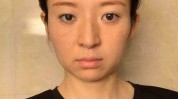 颧骨脸部女子被拉黑(医院颧骨脸部正规这是)
