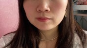 也要双眼皮人去祛斑激光老年(母亲女儿双眼皮手术妈妈)