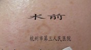 脉冲面部较大激光治疗脂溢性(创面脉冲较大南京术后)
