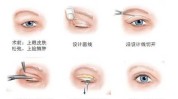 帮你双眼皮手术眼睛方法(双眼皮手术眼睛皮肤帮你)