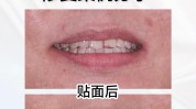 贴面美容院靠谱吗(贴面美容院牙齿口腔牙龈)