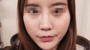彪悍术后小脸见识十斤小时(彪悍吸脂术后面部见识)