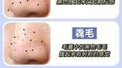细毛黑头眼神方法(毛孔黑头粗大细毛这款)