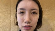 之窗眼部心灵(双眼皮眼部手术之窗眼角)