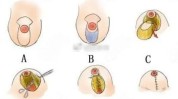 说过你听乳房(乳房瘢痕乳头手术方法)