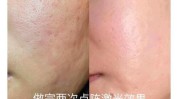 帮你粗大毛孔激光(毛孔粗大皮肤激光肌肤)