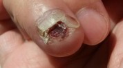 上海门诊指甲患者烦恼(指甲趾甲门诊患者炎症)