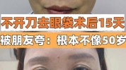 只为深圳大姐外地效果不开刀(只为深圳大姐去眼袋眼袋)