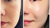 水光做完美容院注意事项有哪些(水光肌肤皮肤做完术后)