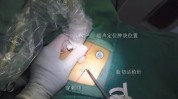 乳腺微创手术旋切是(乳腺病灶顺义微创手术)