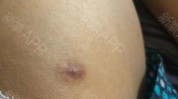 瘢痕醒目额头大腿抽脂腿都瘸(瘢痕大腿额头抽脂女士)
