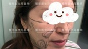 拉皮还不错这几个伴侣哪些项目手术(拉皮手术眼袋基底这几个)