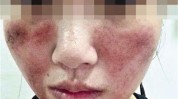 福州红肿美容院面部不当女士(美容院女士福州红肿不当)