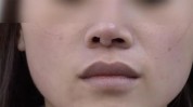 万元隆鼻用手扶着歪了女子(小林莆田鼻梁女人万元)